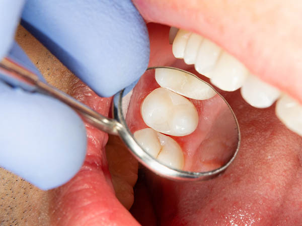 Sealants Teeth Dentist Whitehall Montana Dennis Sacry Dental