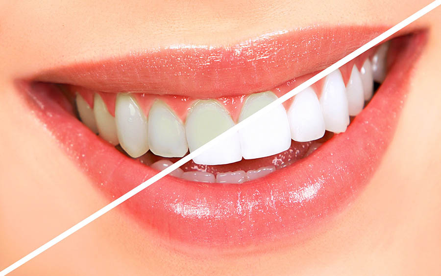 Teeth Whitening Dentist Whitehall Montana Dennis Sacry Dental Page