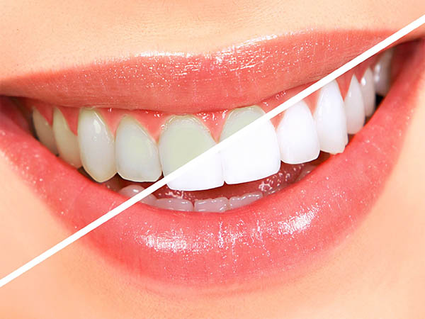 Teeth Whitening Dentist Whitehall Montana Dennis Sacry Dental